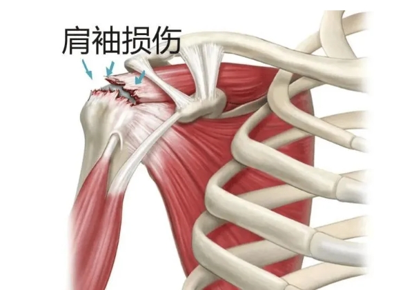 肩膀袖損傷示意圖